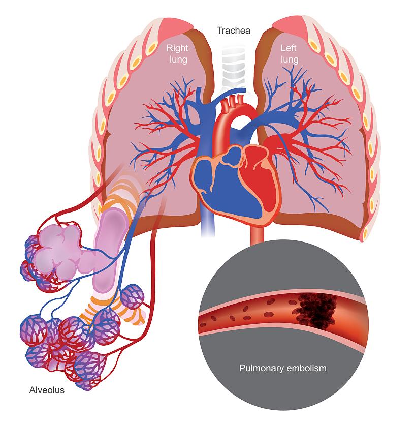 疾病模型|一文了解肺动脉高压模型（PH）的各种建立方法！