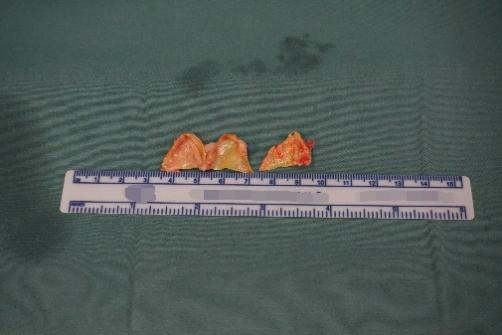 国内首例！西安交通大学第一附属医院成功实施 TAVI 瓣衰败后经肋间微创切口免缝合瓣膜植入手术