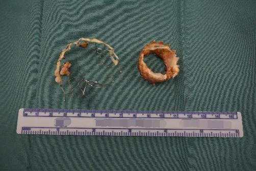 国内首例！西安交通大学第一附属医院成功实施 TAVI 瓣衰败后经肋间微创切口免缝合瓣膜植入手术