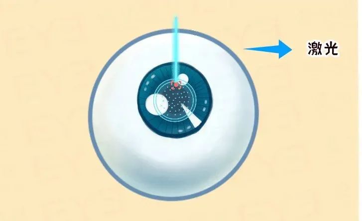 近视手术痛吗？打不打麻药？