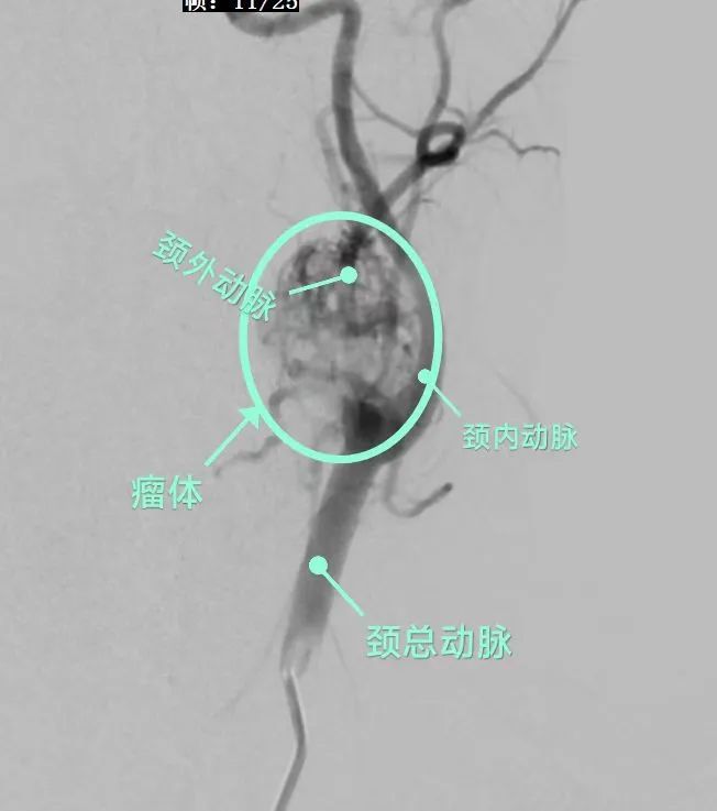 颈动脉体瘤凶险如「树杈上的马蜂窝」！西安高新医院心脏大血管外科精准手术切除