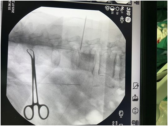 河北燕达医院疼痛科成功实施京东地区第一例鞘内吗啡泵植入术