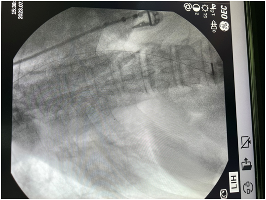 河北燕达医院疼痛科成功实施京东地区第一例鞘内吗啡泵植入术