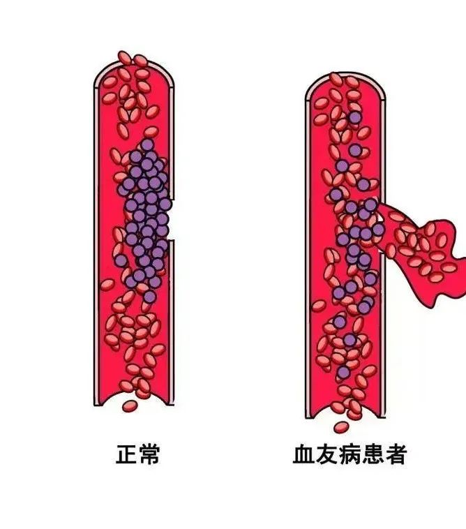 江西省儿童医院为一血友病患儿实施扁桃体切除术