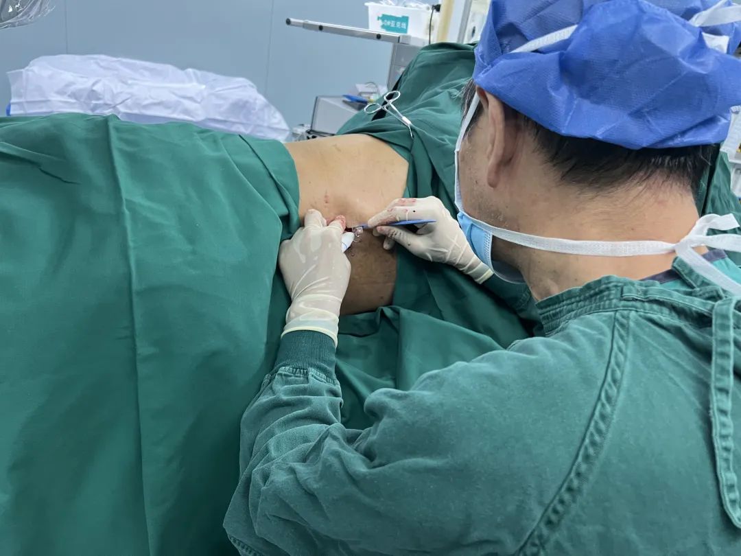 河北燕达医院疼痛科成功实施京东地区第一例鞘内吗啡泵植入术