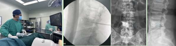 西安交通大学第一附属医院骨科应用复合式冷热消融技术全线贯通治疗脊柱转移瘤