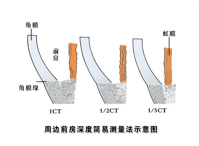 角膜薄，前房浅，为何无缘近视手术？武汉普瑞眼科医院关念主任为您讲解