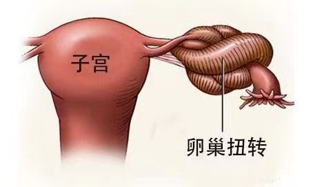 2 岁女童卵巢扭转 360°，江西省儿童医院手术成功救治