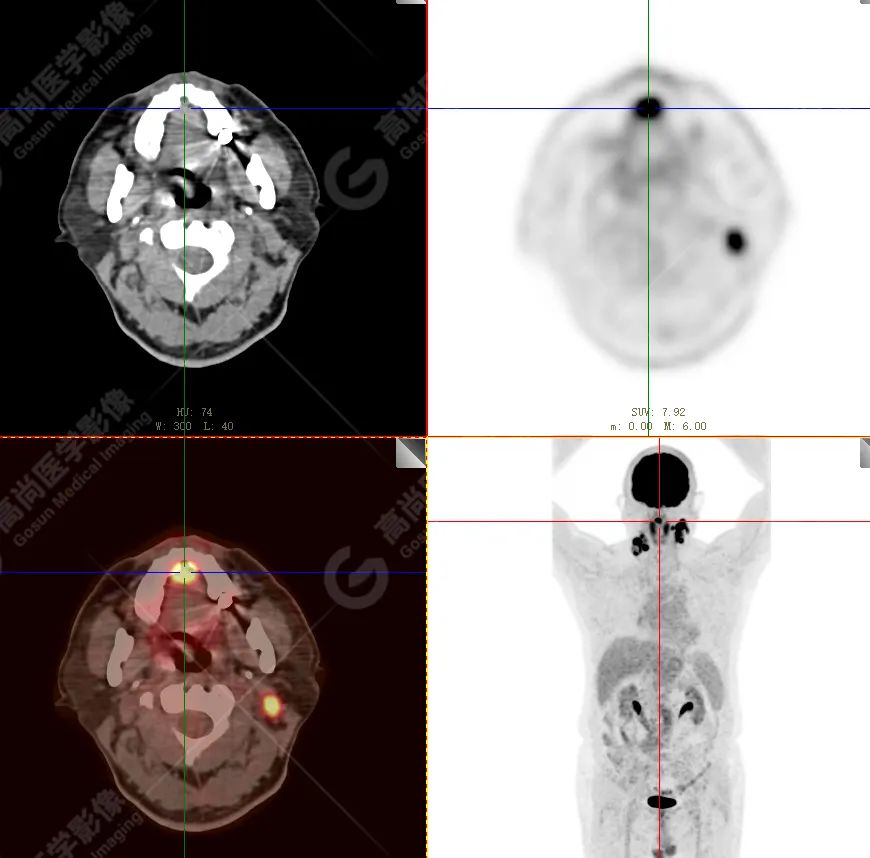 【高尚病例】恶性黑色素瘤