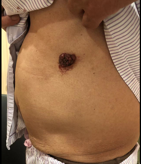 【高尚病例】恶性黑色素瘤