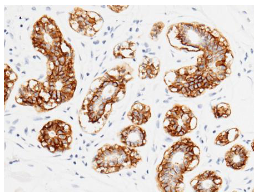 泛癌热门靶点TROP2及研究工具试剂