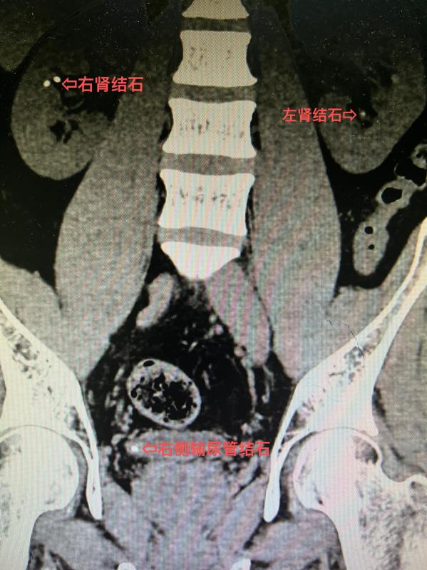 延安市中医医院(北京大学第三医院延安分院)泌尿外科救治双肾结石合并右侧输尿管结石患者