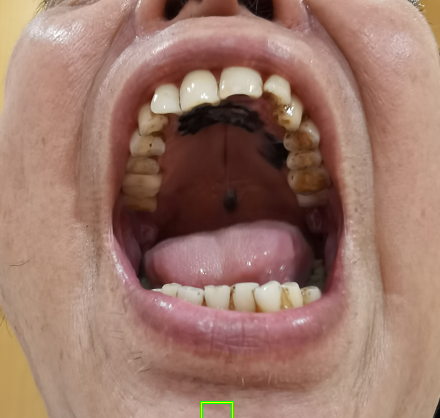 【高尚病例】恶性黑色素瘤