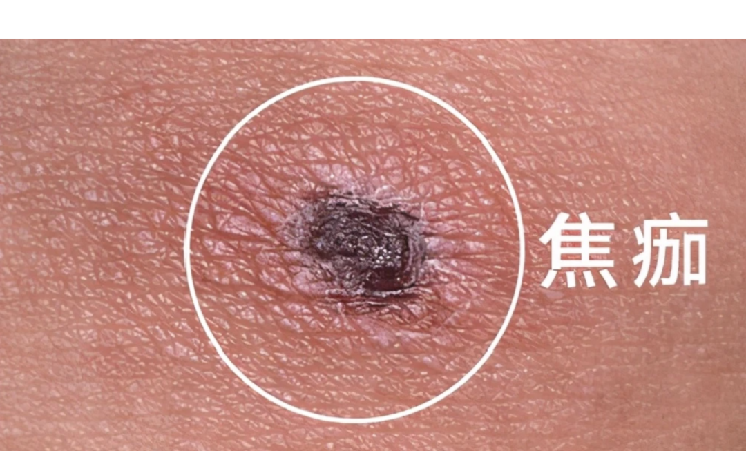 高烧不退还进 ICU，罪魁祸首竟是这种虫子