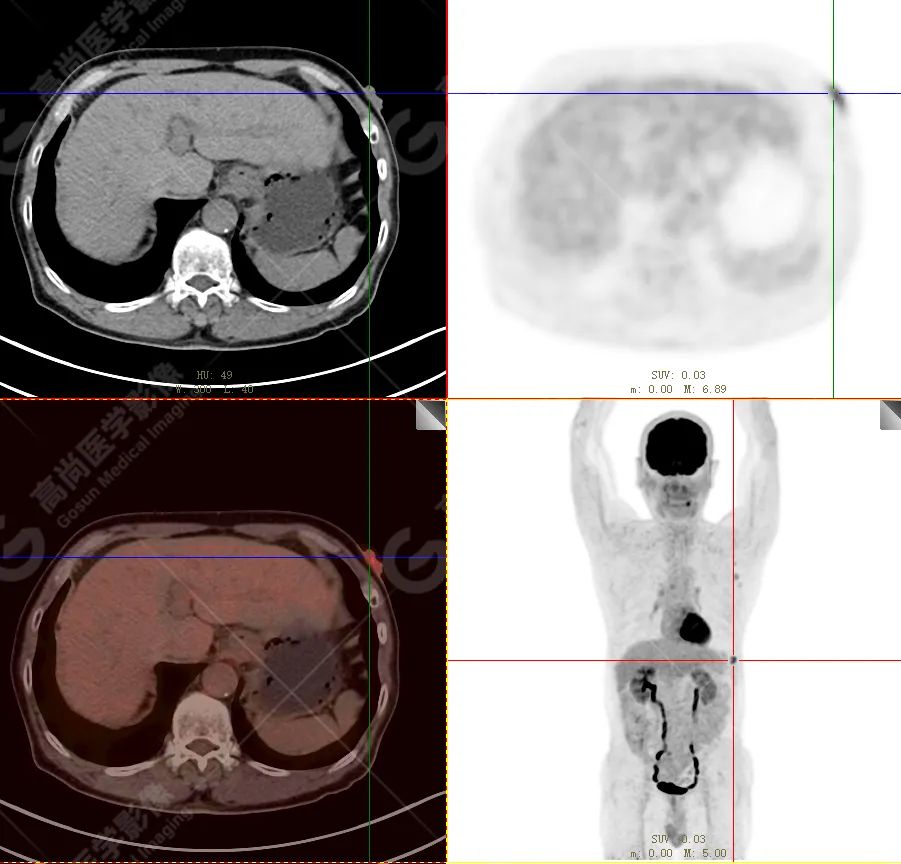 【高尚病例】恶性黑色素瘤
