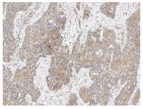 泛癌热门靶点TROP2及研究工具试剂