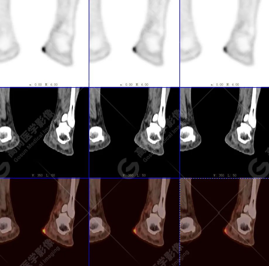 【高尚病例】恶性黑色素瘤