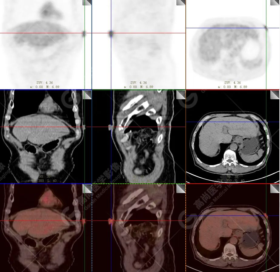 【高尚病例】恶性黑色素瘤