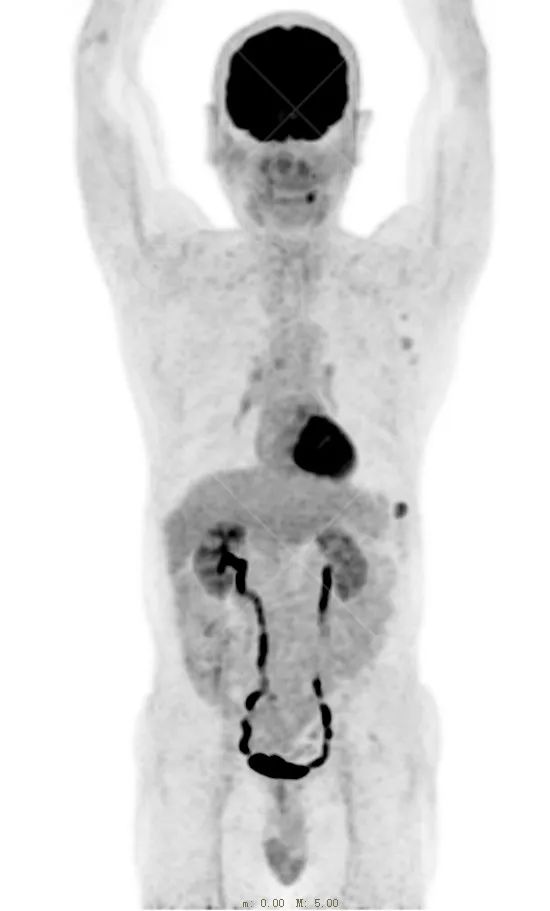 【高尚病例】恶性黑色素瘤
