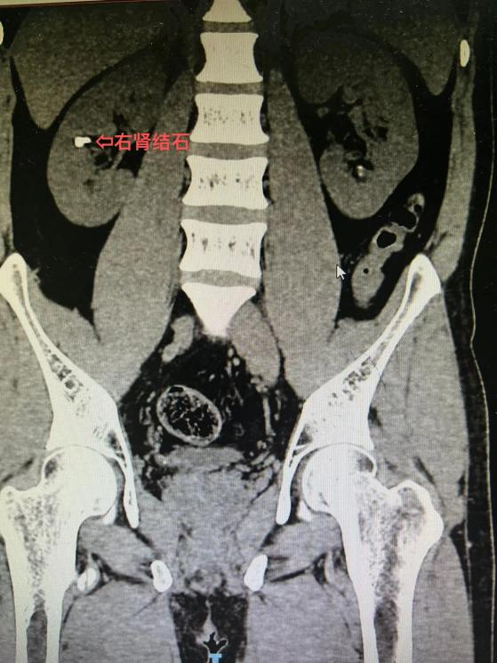 延安市中医医院(北京大学第三医院延安分院)泌尿外科救治双肾结石合并右侧输尿管结石患者