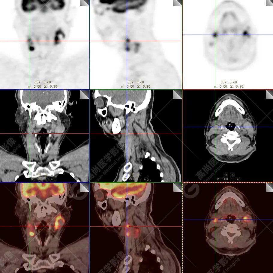 【高尚病例】恶性黑色素瘤