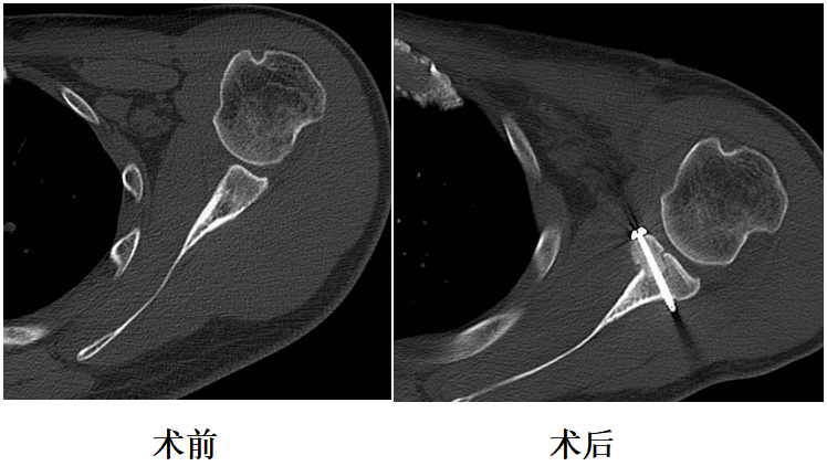 肩关节手术——全关节镜下嵌入式喙突移位术（Cuistow）在延安落地开花