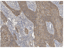 泛癌热门靶点TROP2及研究工具试剂