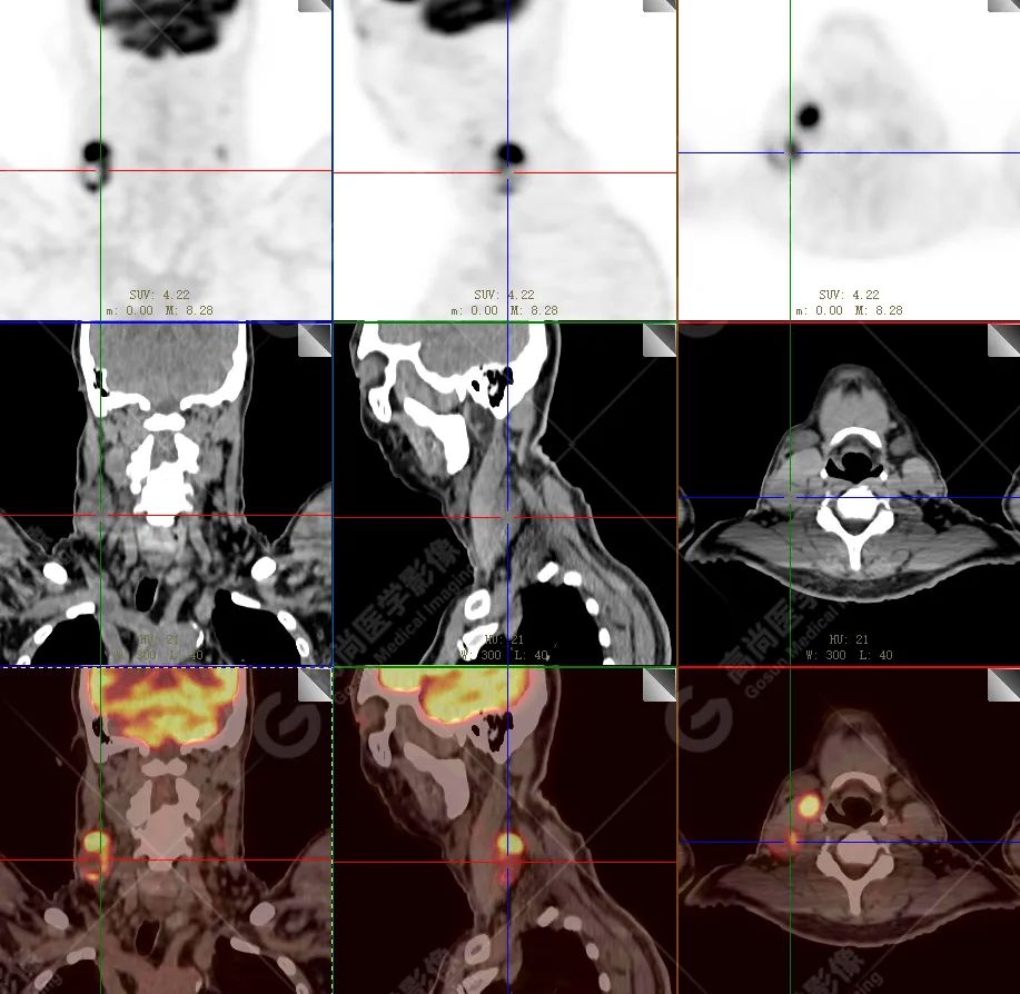 【高尚病例】恶性黑色素瘤