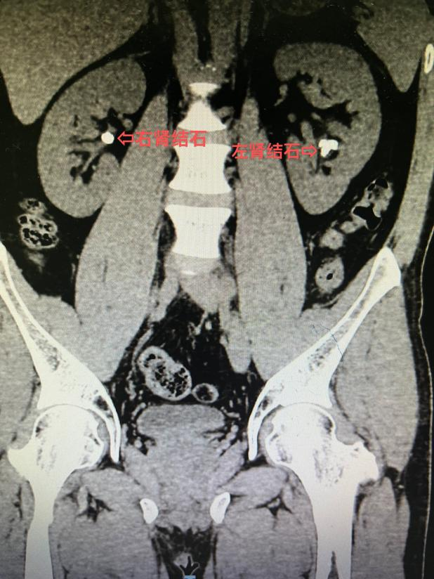 延安市中医医院(北京大学第三医院延安分院)泌尿外科救治双肾结石合并右侧输尿管结石患者