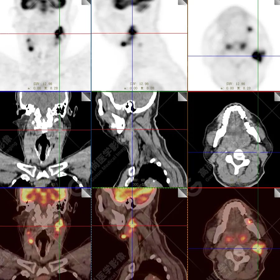 【高尚病例】恶性黑色素瘤