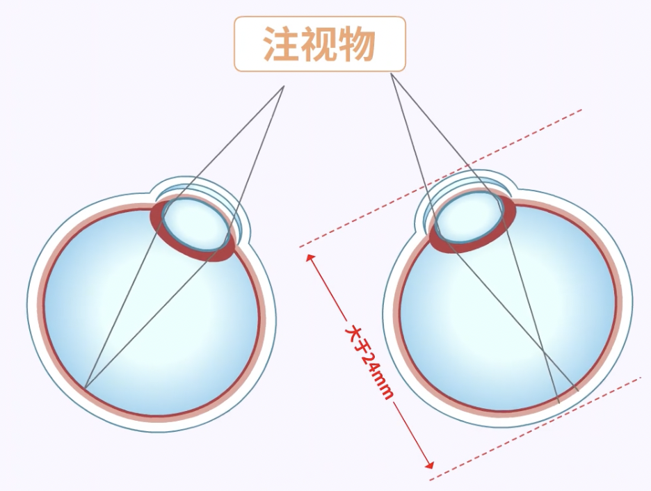 看完这个,我再也不敢侧躺玩手机了……