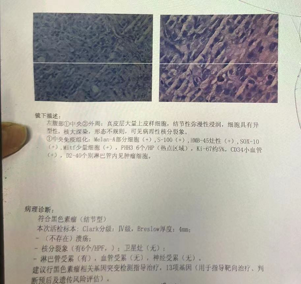 【高尚病例】恶性黑色素瘤