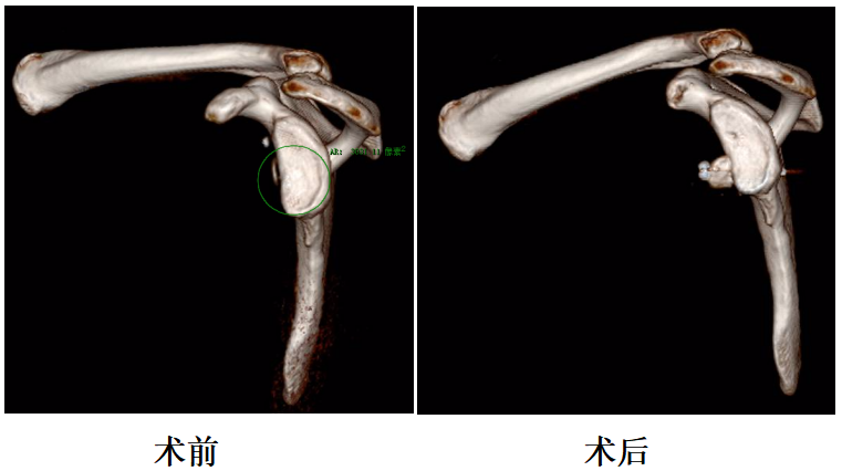 肩关节手术——全关节镜下嵌入式喙突移位术（Cuistow）在延安落地开花