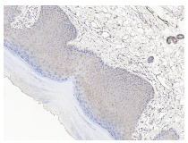 泛癌热门靶点TROP2及研究工具试剂