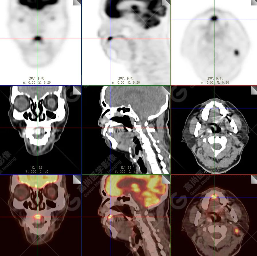 【高尚病例】恶性黑色素瘤