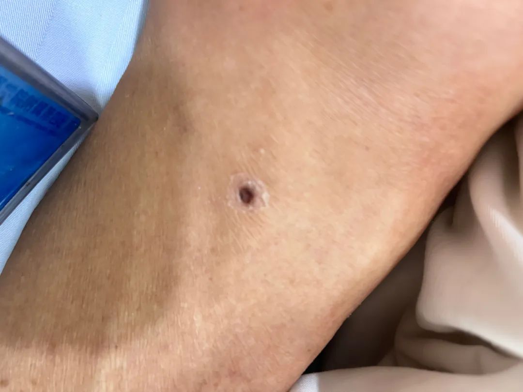 高烧不退还进 ICU，罪魁祸首竟是这种虫子