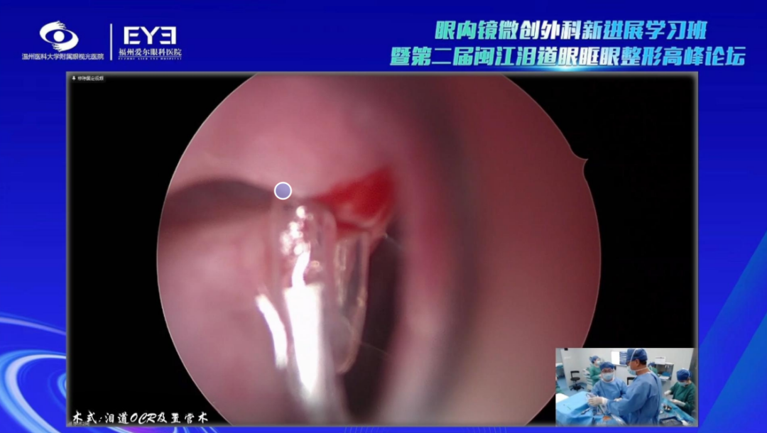 ​国家级继教班「第二届闽江泪道眼眶眼整形高峰论坛」在榕举办！大咖手术直播、解剖示教、专题授课，展学术饕餮盛宴