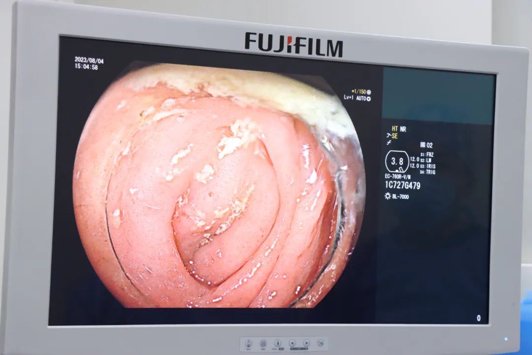 西安高新医院成功为一名急性阑尾炎患者实施院内首例 ERAT 术