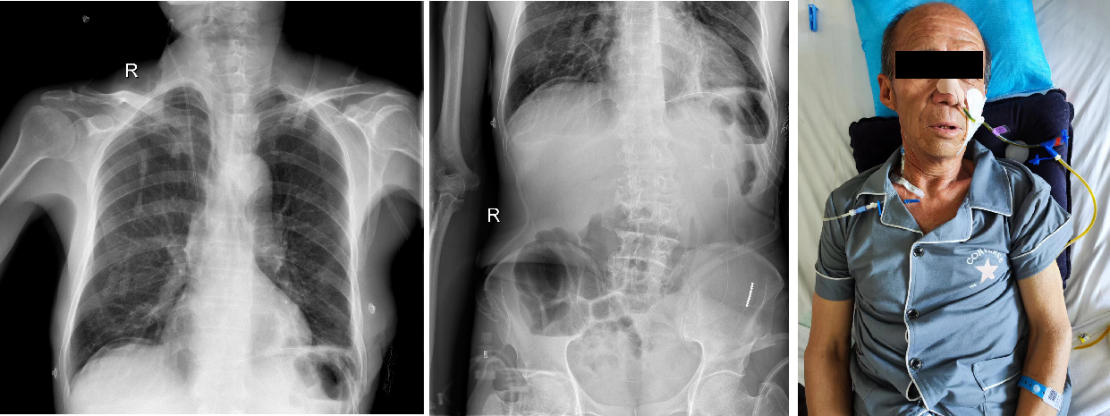 西安交大二附院胸外科完成一例经左胸入路远端食管-全胃切除+空肠-食管 Roux-en-Y 吻合术