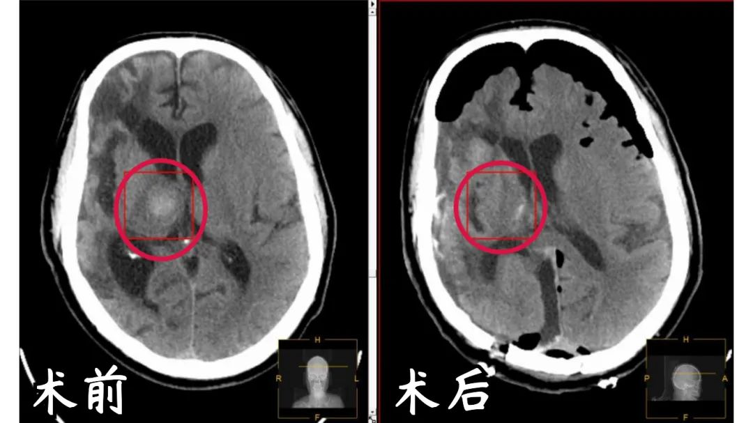 头晕头痛小心是「烟雾病」，一旦发病危及生命！