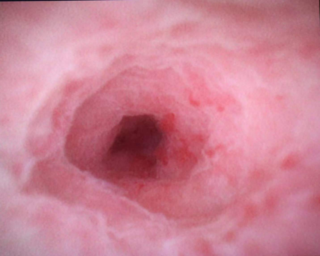 西安高新医院成功为一名急性阑尾炎患者实施院内首例 ERAT 术