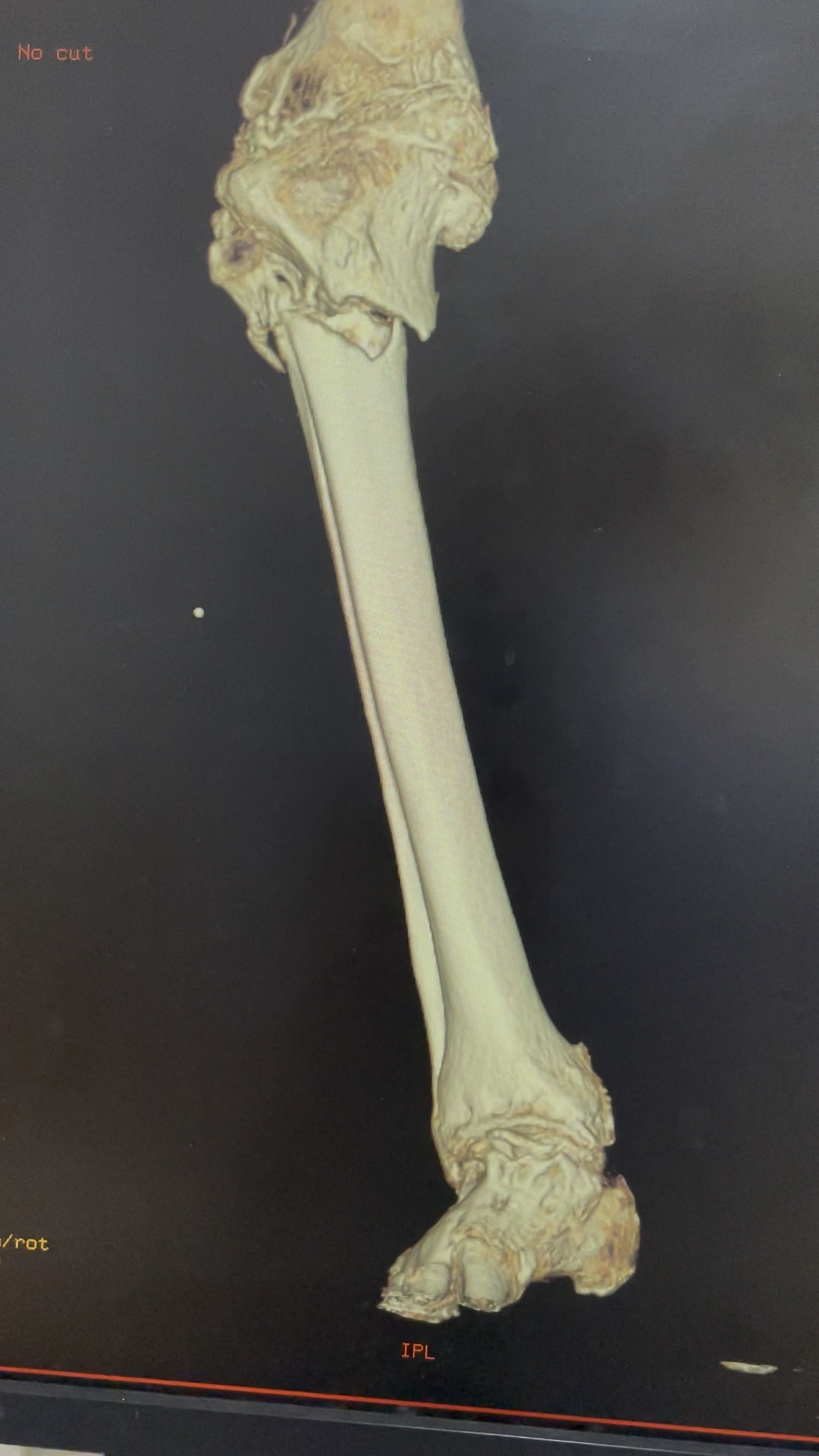 请教这个胫腓骨上端骨折该如何处理