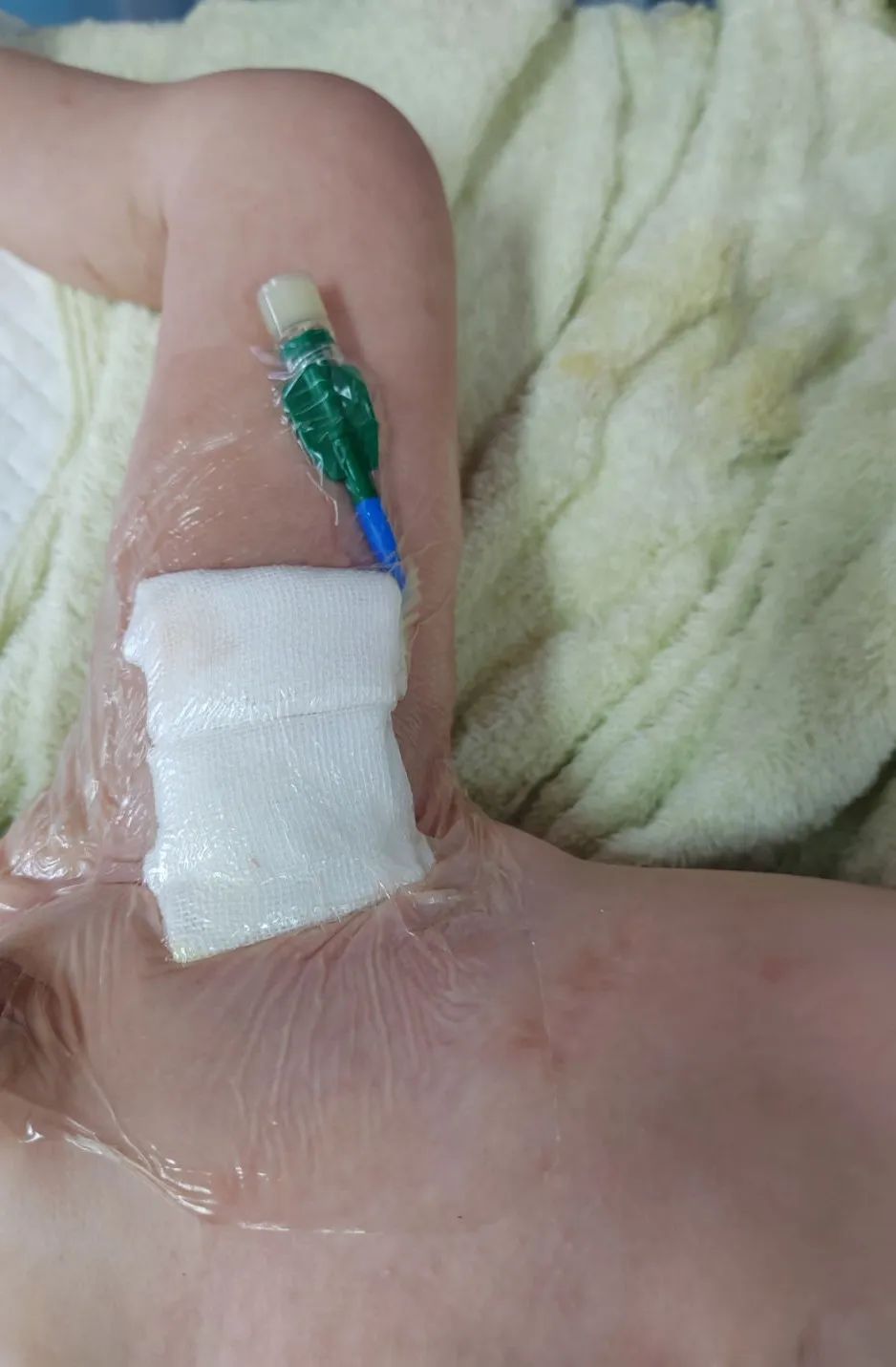 江西省儿童医院隧道式 PICC 置管术为 1 岁男童搭建安全「生命通道」