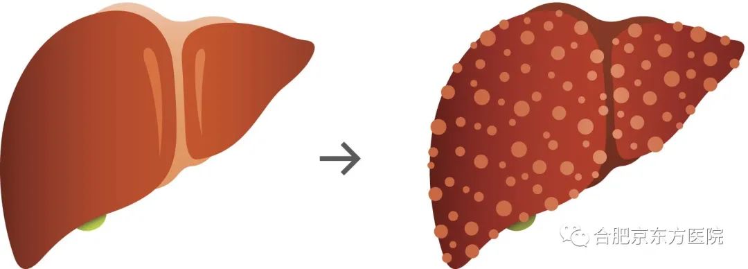 世界肝炎日，合肥京东方医院医生为您解答肝病疑惑