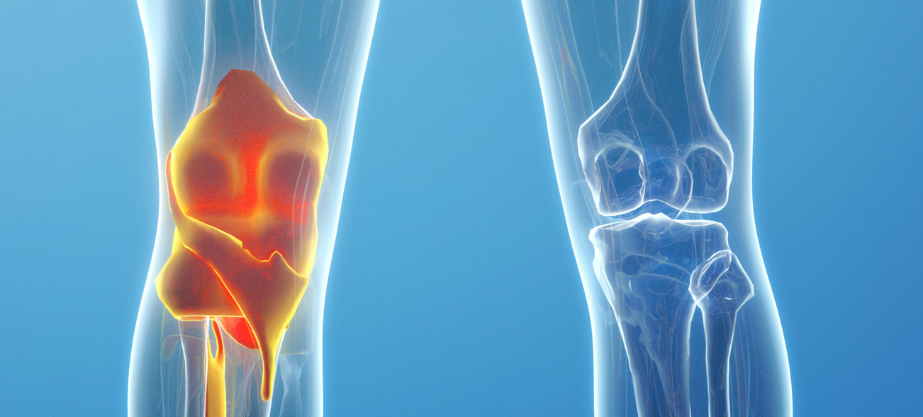 论文分享 | 骨关节炎治疗新方法→可注射水凝胶