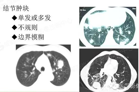 【高尚病例】体检发现右肺下叶团片影，PET/CT 诊断肺 MALT 淋巴瘤