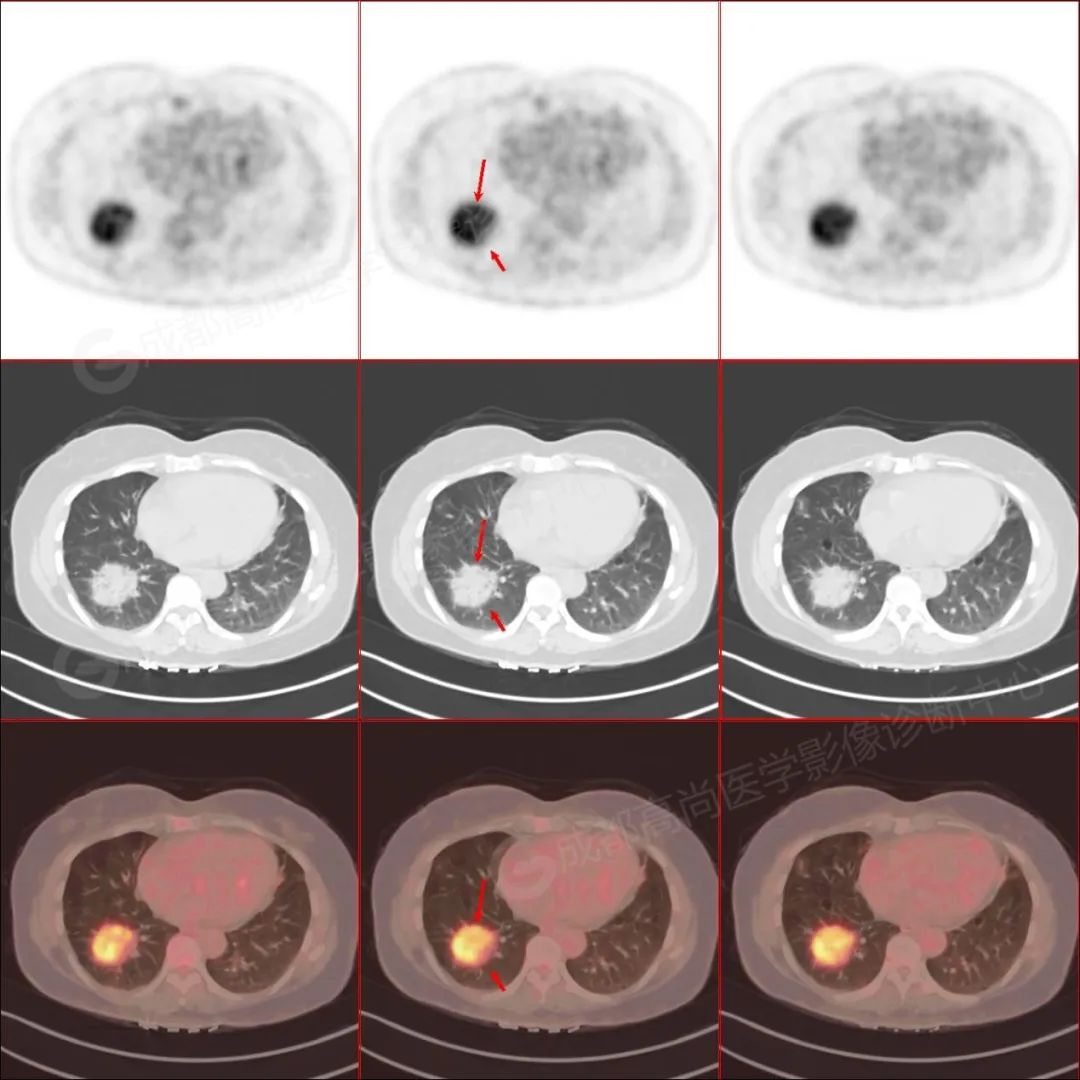 【高尚病例】体检发现右肺下叶团片影，PET/CT 诊断肺 MALT 淋巴瘤