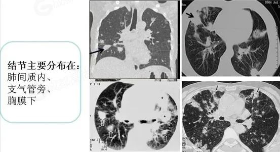 【高尚病例】体检发现右肺下叶团片影，PET/CT 诊断肺 MALT 淋巴瘤