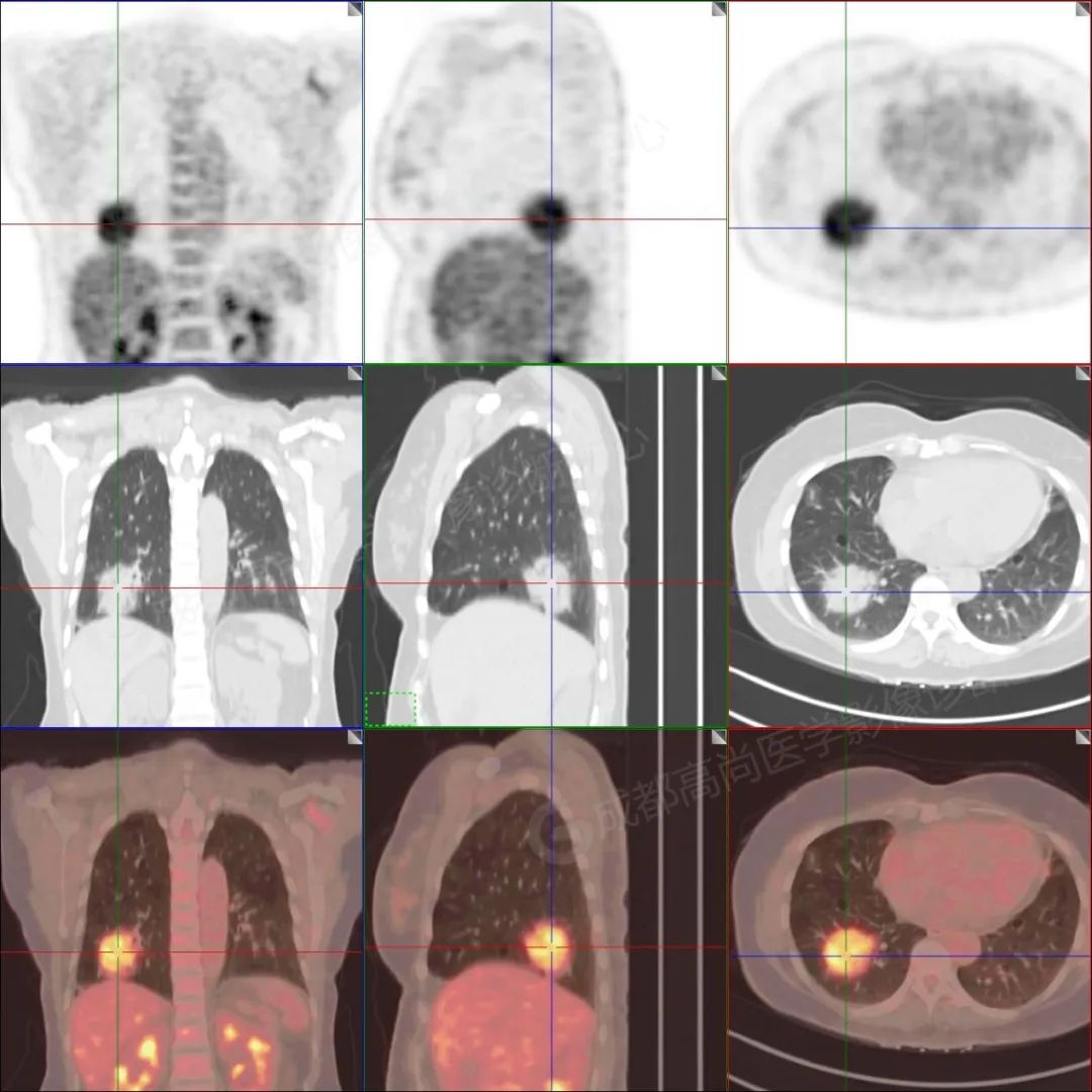 【高尚病例】体检发现右肺下叶团片影，PET/CT 诊断肺 MALT 淋巴瘤