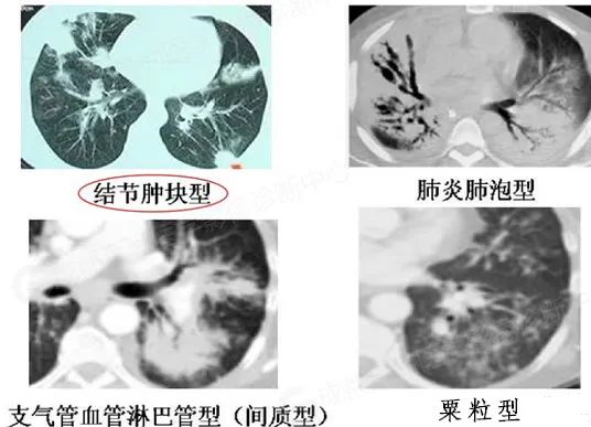 【高尚病例】体检发现右肺下叶团片影，PET/CT 诊断肺 MALT 淋巴瘤